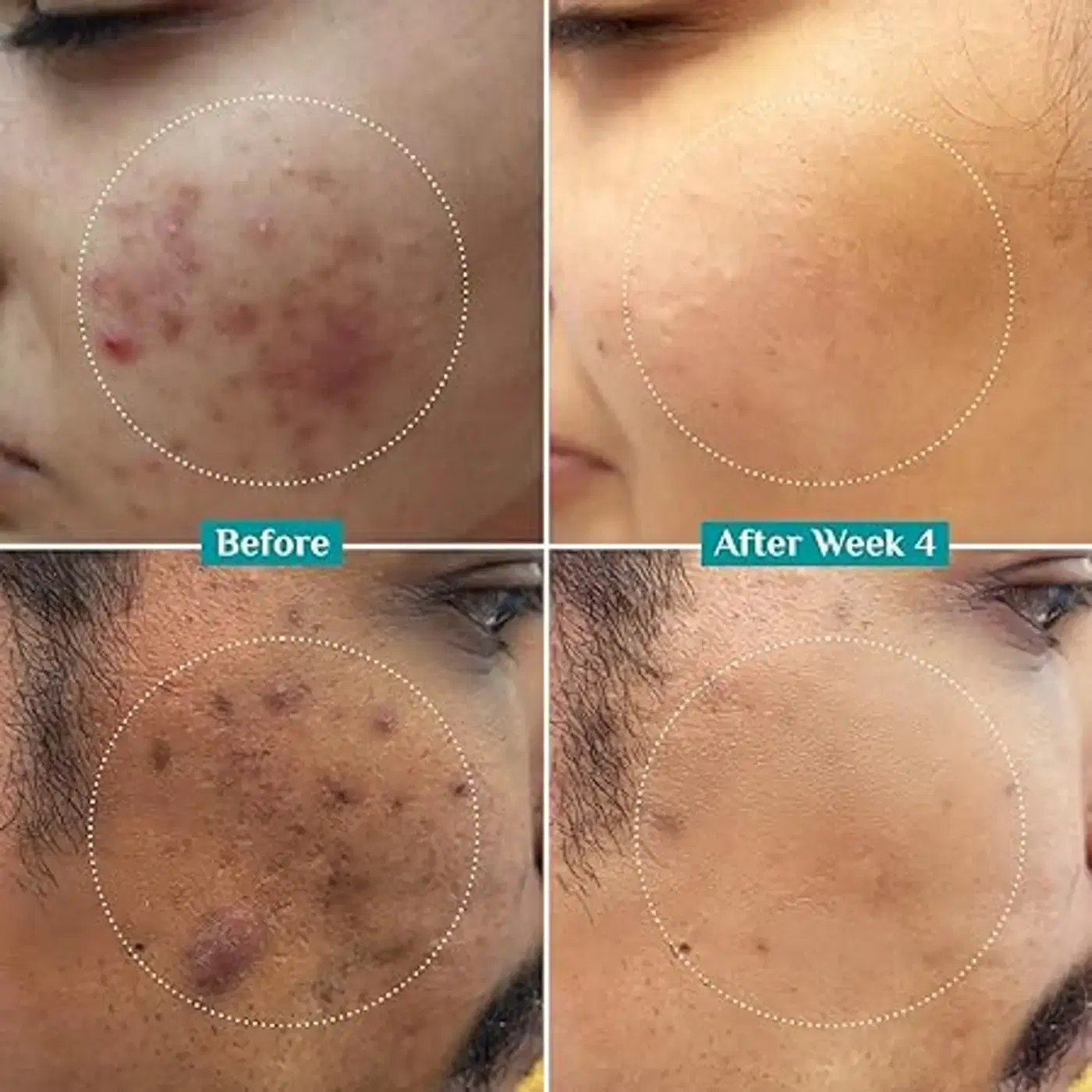 Pilgrim Niacinamide Face Serum for Clear, Bright & Smooth Skin 5 Pilgrim 10% Niacinamide Serum 30ml For Acne Marks|With 1% Zinc PCA, Salicylic & Hyaluronic Acid|Niacinamide Serum For Oily Skin, Acne-Prone, Combination, Normal Skin|Oil Control, Anti-Acne|Women & Men 5